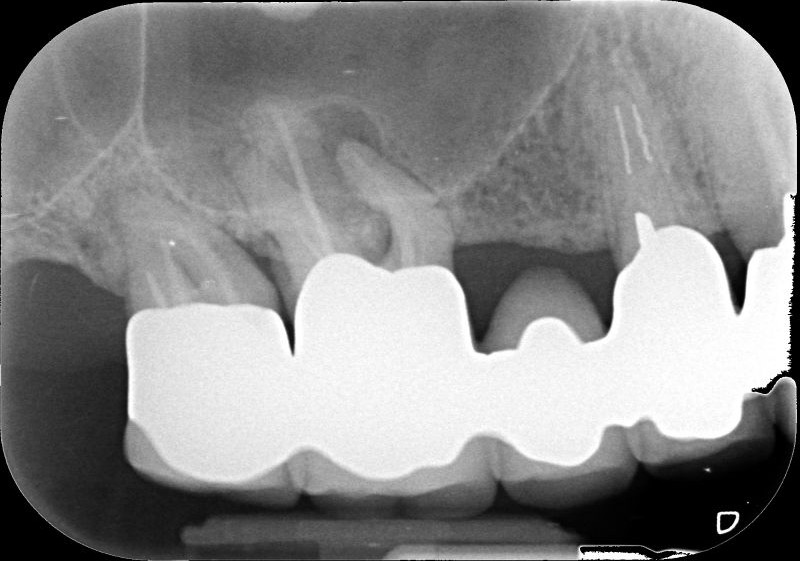 Quanto costa devitalizzare un dente - Pessima terapia endodontica