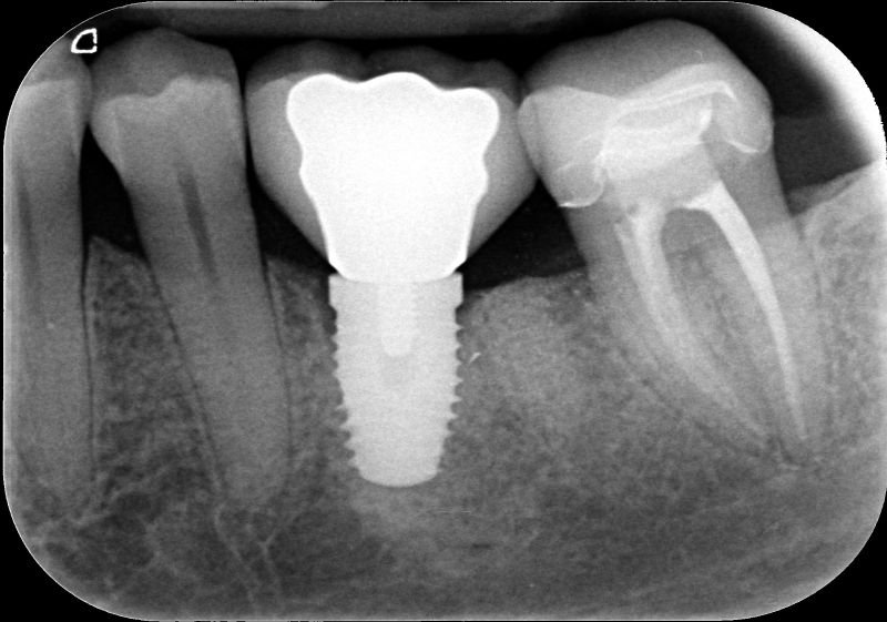 Quanto costa devitalizzare un dente - Corretta terapia endodontica