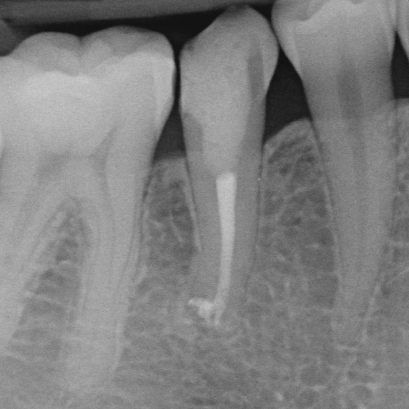 Cosa incide sui costi devitalizzazione dente?
