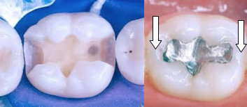 La terapia endodontica rende i denti fragili? - Faggian Clinic