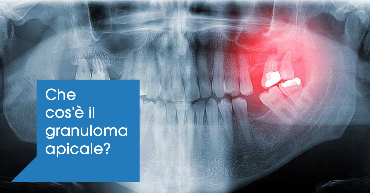 Granuloma apicale: sintomi e cura - Faggian Clinic