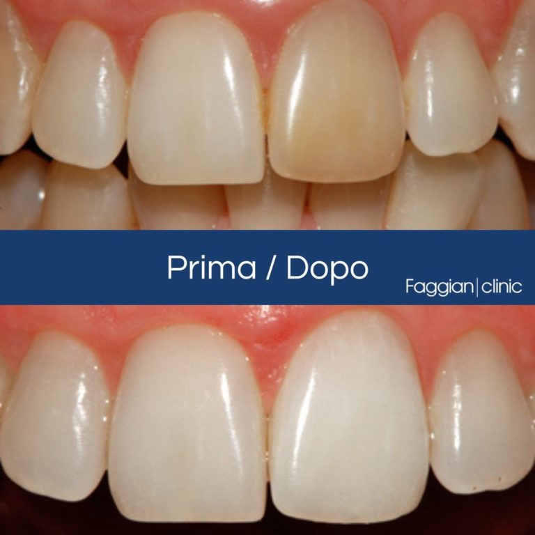 Sbiancamento Dentale, La Guida Completa - Foto 5