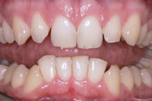 Ortodonzia adulti: prima