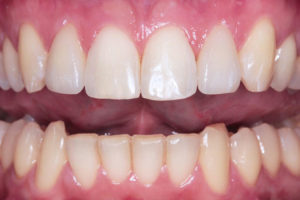 Ortodonzia adulti: dopo