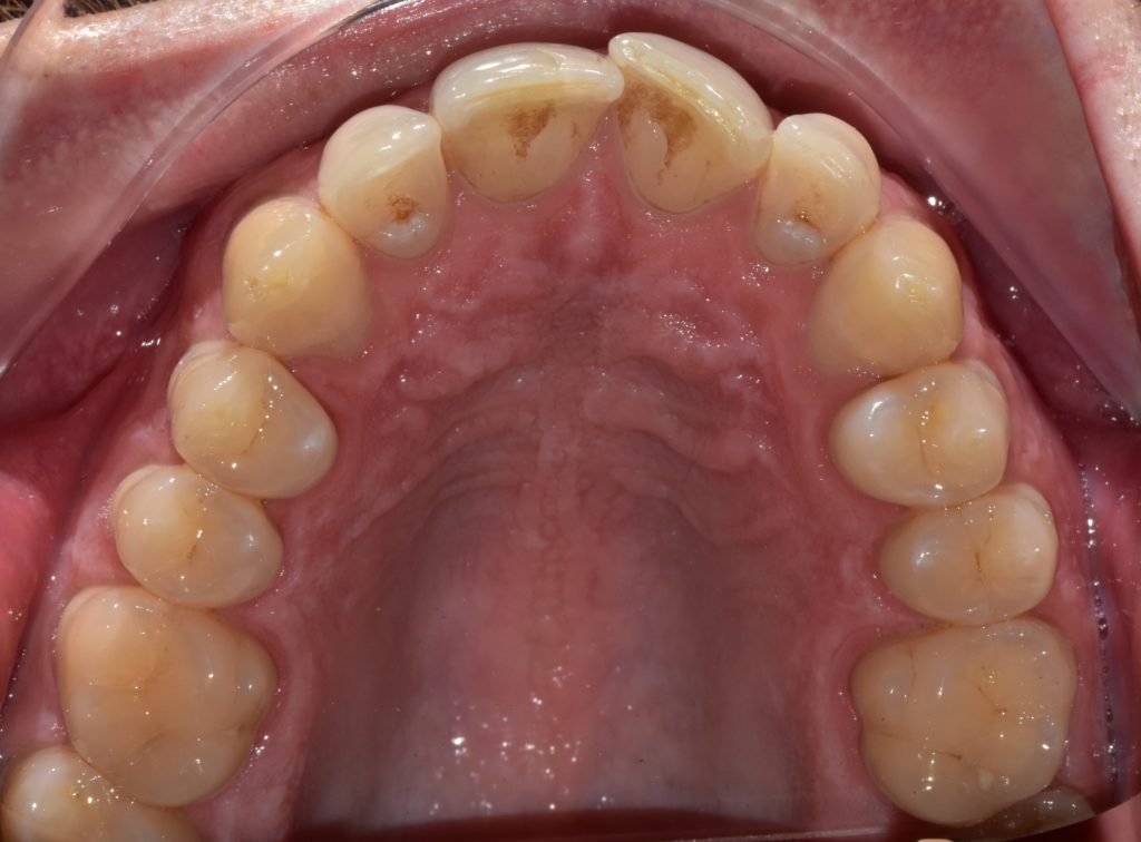 Raddrizzare i denti da adulti: prima