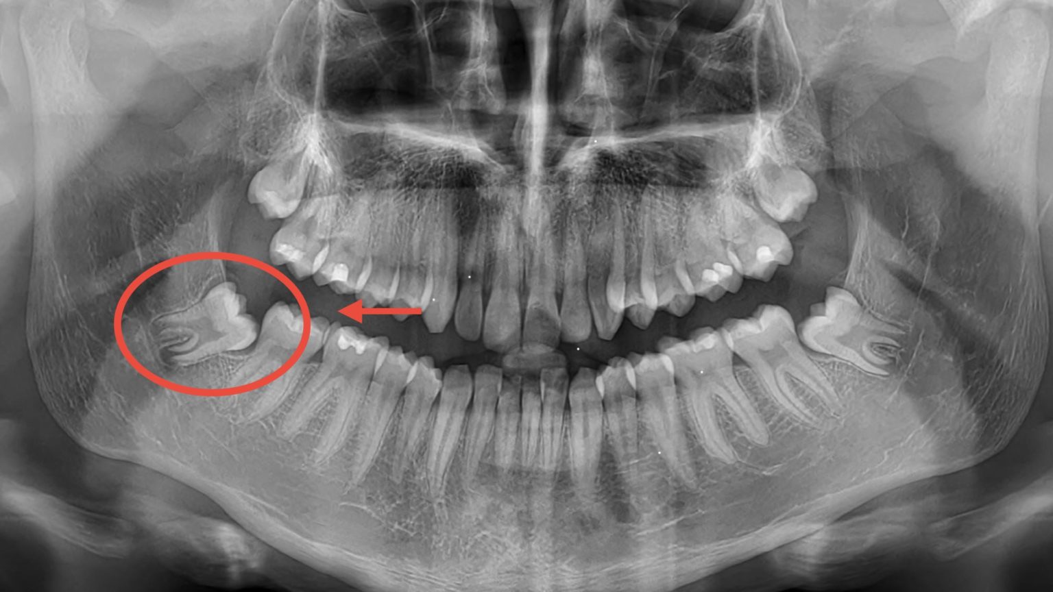 Estrazione del dente del giudizio - Faggian Clinic
